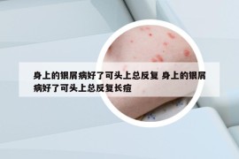 身上的银屑病好了可头上总反复 身上的银屑病好了可头上总反复长痘