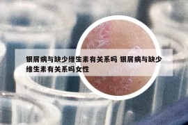 银屑病与缺少维生素有关系吗 银屑病与缺少维生素有关系吗女性