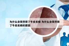 为什么会突然得了牛皮皮癣 为什么会突然得了牛皮皮癣的原因