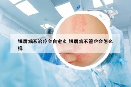 银屑病不治疗会自愈么 银屑病不管它会怎么样