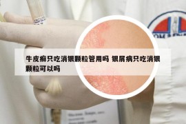 牛皮癣只吃消银颗粒管用吗 银屑病只吃消银颗粒可以吗