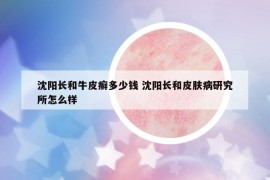 沈阳长和牛皮癣多少钱 沈阳长和皮肤病研究所怎么样