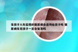 生孩子八年后得的银屑病会遗传给孩子吗 银屑病生完孩子一定会复发吗