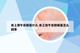 身上像牛皮癣是什么 身上有牛皮肤癣是怎么回事