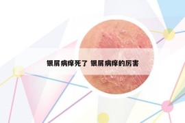 银屑病痒死了 银屑病痒的厉害