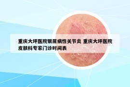 重庆大坪医院银屑病性关节炎 重庆大坪医院皮肤科专家门诊时间表