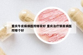 重庆牛皮癣病医院哪家好 重庆治疗银屑病医院哪个好