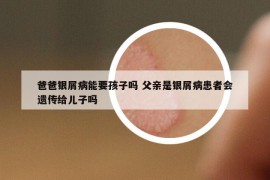 爸爸银屑病能要孩子吗 父亲是银屑病患者会遗传给儿子吗