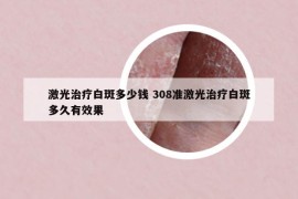 激光治疗白斑多少钱 308准激光治疗白斑多久有效果