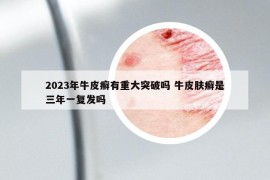 2023年牛皮癣有重大突破吗 牛皮肤癣是三年一复发吗