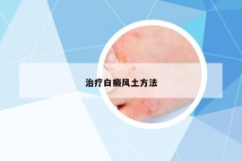 治疗白癜风土方法