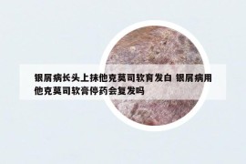 银屑病长头上抹他克莫司软育发白 银屑病用他克莫司软膏停药会复发吗