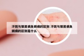 汗斑与银屑病鱼鳞病的区别 汗斑与银屑病鱼鳞病的区别是什么