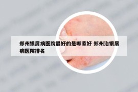 郑州银屑病医院最好的是哪家好 郑州治银屑病医院排名