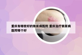 重庆有哪些好的银屑病医院 重庆治疗银屑病医院哪个好