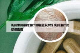 衡阳银屑病的治疗价格是多少钱 衡阳治疗皮肤病医院