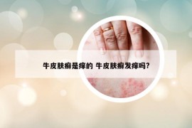 牛皮肤癣是痒的 牛皮肤癣发痒吗?