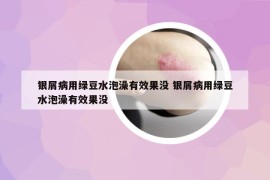 银屑病用绿豆水泡澡有效果没 银屑病用绿豆水泡澡有效果没