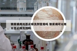 银屑病用川百止痒洗剂管用吗 银屑病可以用川百止痒洗剂吗