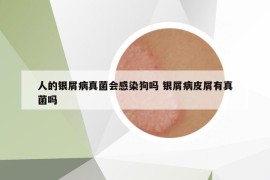 人的银屑病真菌会感染狗吗 银屑病皮屑有真菌吗