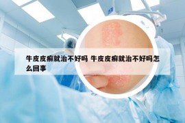 牛皮皮癣就治不好吗 牛皮皮癣就治不好吗怎么回事