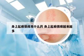 身上起癣很痒用什么药 身上起癣很痒越来越多