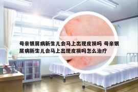 母亲银屑病新生儿会马上出现皮损吗 母亲银屑病新生儿会马上出现皮损吗怎么治疗