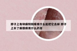 脖子上有块癣特别痒用什么能把它去掉 脖子上长了癣很痒用什么药膏