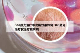 308激光治疗牛皮癣效果如何 308激光治疗仪治疗银屑病