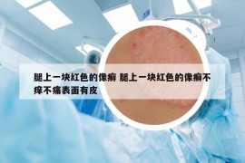 腿上一块红色的像癣 腿上一块红色的像癣不痒不痛表面有皮