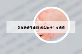 怎样治疗牛皮藓 怎么治疗牛皮病癣