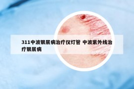 311中波银屑病治疗仪灯管 中波紫外线治疗银屑病