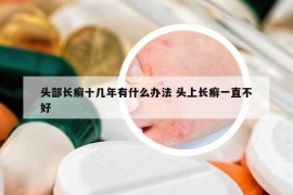 头部长癣十几年有什么办法 头上长癣一直不好