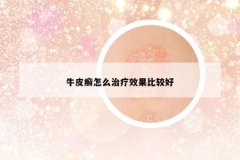 牛皮癣怎么治疗效果比较好