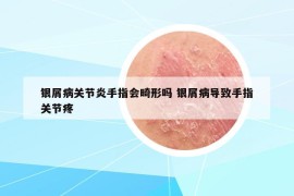 银屑病关节炎手指会畸形吗 银屑病导致手指关节疼