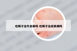 吃蝎子治牛皮癣吗 吃蝎子治皮肤病吗