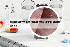 银屑病治好了会遗传给孩子吗 得了银屑病最后好了