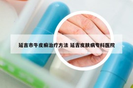 延吉市牛皮癣治疗方法 延吉皮肤病专科医院