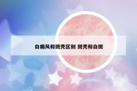 白癜风和斑秃区别 斑秃和白斑