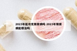 2023年能攻克银屑病吗 2023年银屑病能根治吗