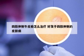 四肢伸侧牛皮癣怎么治疗 好发于四肢伸侧的皮肤病