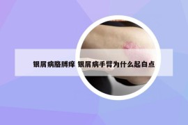 银屑病胳膊痒 银屑病手臂为什么起白点