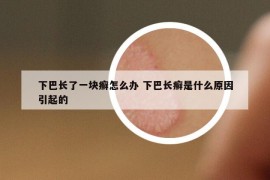 下巴长了一块癣怎么办 下巴长癣是什么原因引起的