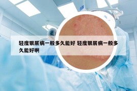 轻度银屑病一般多久能好 轻度银屑病一般多久能好啊