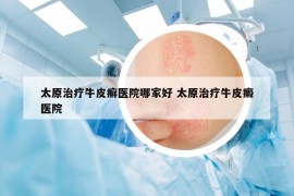 太原治疗牛皮癣医院哪家好 太原治疗牛皮癜医院