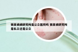 银屑病病研究所是公立医院吗 银屑病研究所是私立还是公立