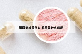 银屑症状是什么 银屑是什么病啊