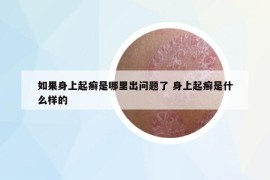 如果身上起癣是哪里出问题了 身上起癣是什么样的