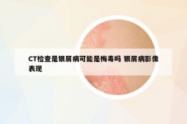 CT检查是银屑病可能是梅毒吗 银屑病影像表现