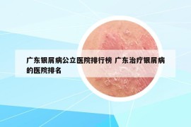 广东银屑病公立医院排行榜 广东治疗银屑病的医院排名